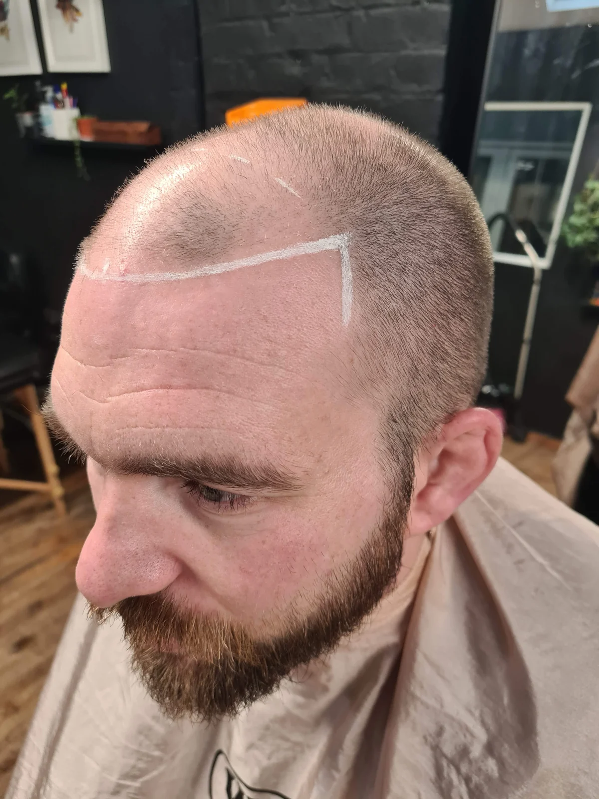 Hairline design planning before SMP treatment