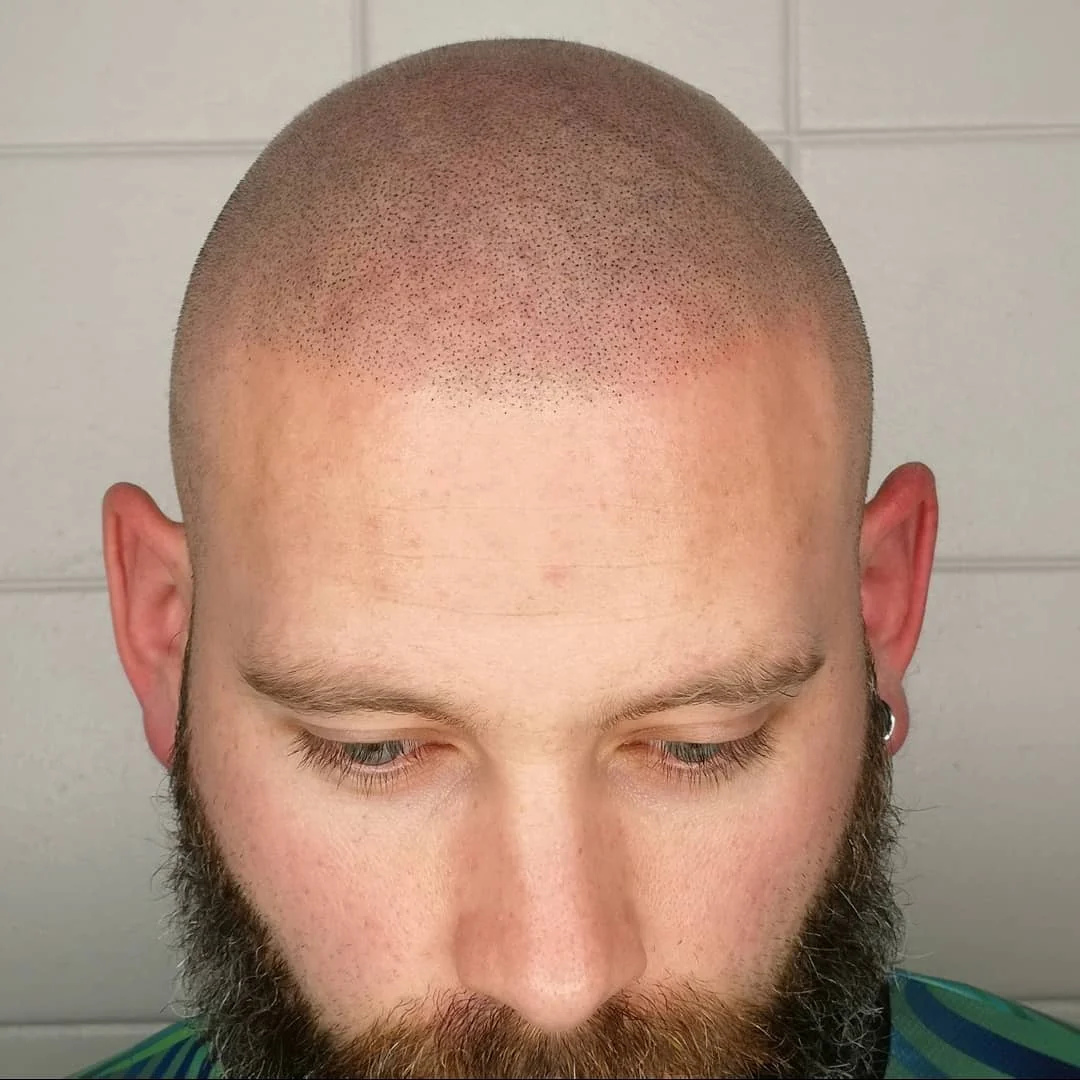 John after his own scalp micropigmentation treatment
