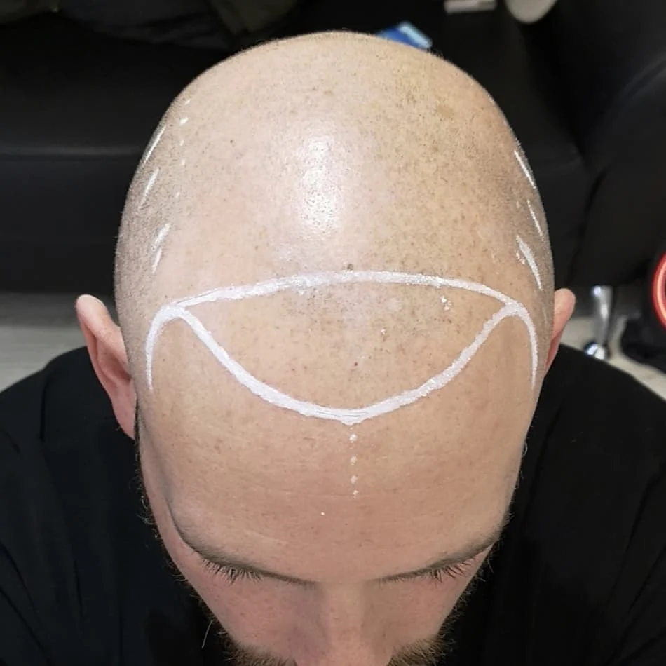 John before his own scalp micropigmentation treatment