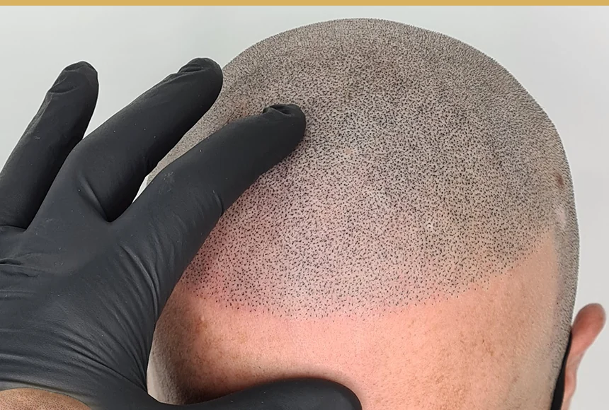 Close scalp micropigmentation treatment result